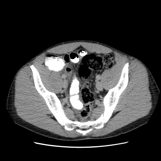Appendicitis complicated by post-operative collection (Radiopaedia 35595-37113 A 62).jpg