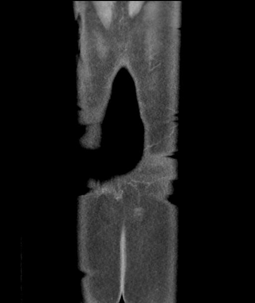 Appendicitis with cecal bar sign (Radiopaedia 31878-32830 A 59).jpg