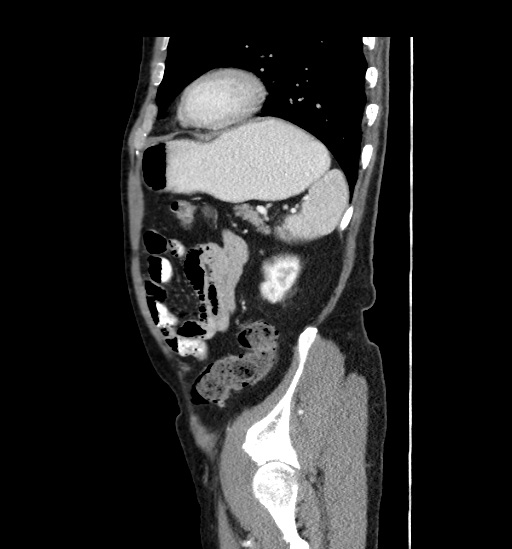 Appendicitis with localized perforation and abscess formation (Radiopaedia 49035-54130 C 51).jpg