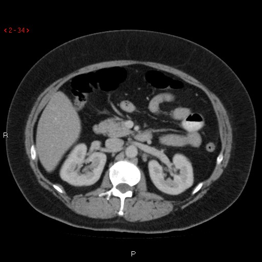 File:Appendicitis with microperforation- promontoric type (Radiopaedia 27268-27442 C 22).jpg