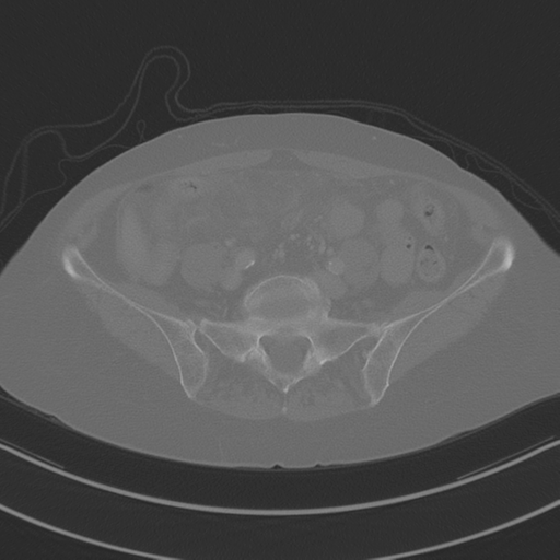 April fools' 2019- calcified peritoneal arachnoidosis (Radiopaedia 67273-76636 Axial bone window 33).png