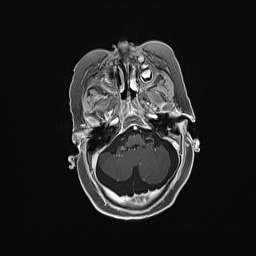 Aqueductal stenosis (Radiopaedia 73974-84802 Axial T1 C+ 47).jpg
