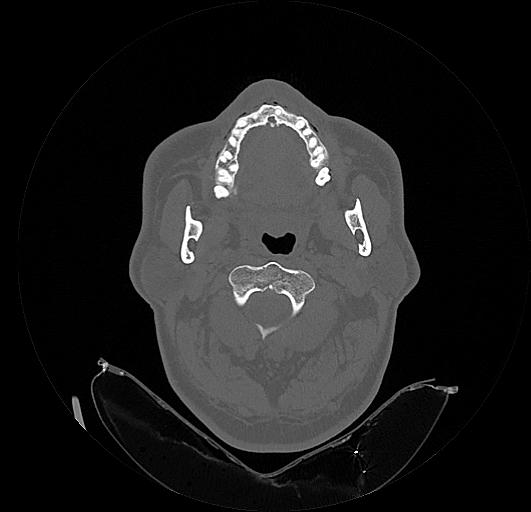 Arcuate foramen (Radiopaedia 89833-106944 Axial bone window 52).jpg