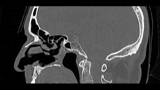 File:Arcuate foramen (Radiopaedia 89833-106944 Sagittal bone window 61).jpg