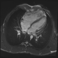 File:Arrhythmogenic right ventricular cardiomyopathy (Radiopaedia 57972-64966 A 2).jpg