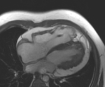 Arrhythmogenic right ventricular cardiomyopathy (Radiopaedia 69431-79307 4ch cine 48).jpg
