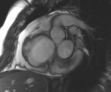 Arrhythmogenic right ventricular cardiomyopathy (Radiopaedia 69431-79307 Short axis cine 215).jpg