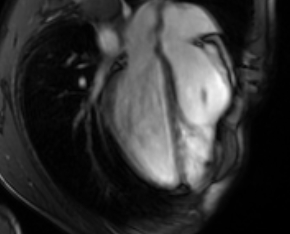 Arrhythmogenic right ventricular cardiomyopathy (Radiopaedia 69564-79464 4ch cine 73).jpg
