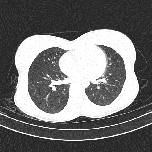 Arteria lusoria (Radiopaedia 88528-105192 Axial lung window 40).jpg