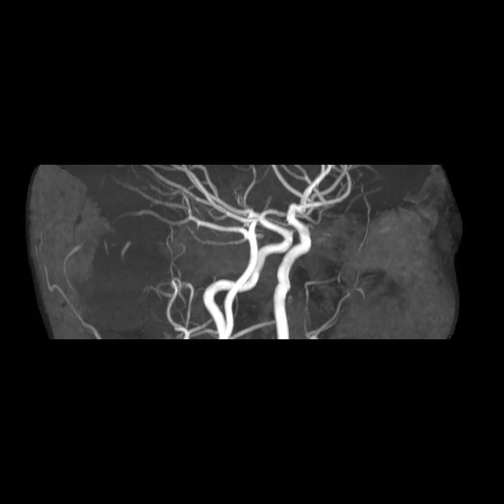File:Artery of Percheron infarct (Radiopaedia 40966-43676 G 10).jpg