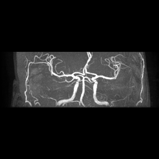 File:Artery of Percheron infarction (Radiopaedia 27975-28230 3D TOF 12).jpg