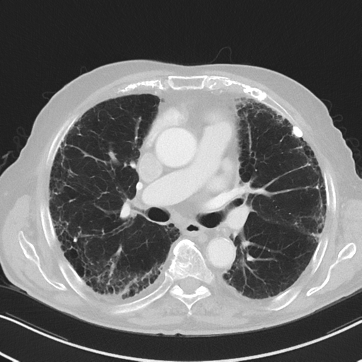 File:Asbestosis (Radiopaedia 56192-62864 Axial lung window 31).png