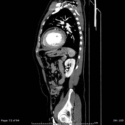 Ascending aortic aneurysm (Radiopaedia 50086-55404 C 51).jpg