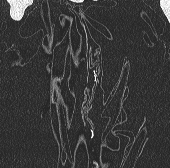 Aspergilloma- with Monod sign (Radiopaedia 44737-48532 Coronal lung window 78).jpg