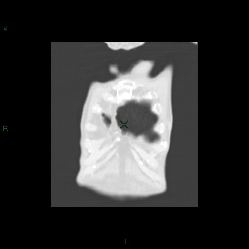 File:Aspergilloma (Radiopaedia 14842-14787 Coronal lung window 3).jpg