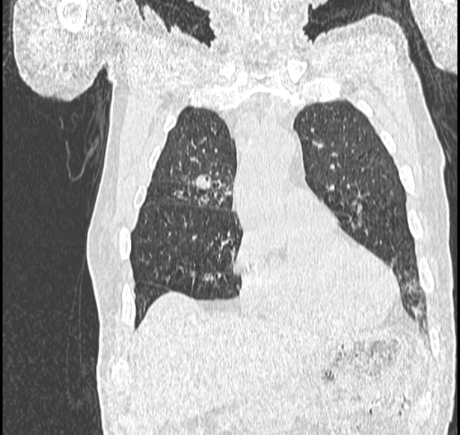 Aspergilloma (Radiopaedia 44592-48327 Coronal lung window 30).jpg
