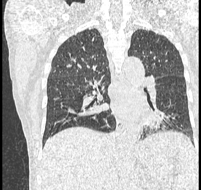 Aspergilloma (Radiopaedia 44592-48327 Coronal lung window 79).jpg