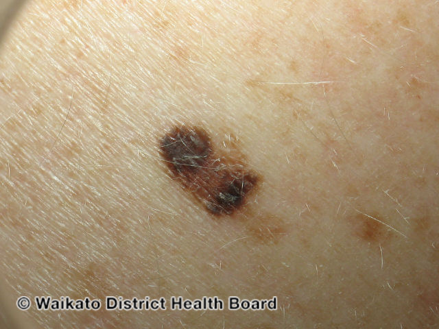 File:Asymmetry of shape, structure and colour (DermNet NZ melanoma-abcd-01).jpg
