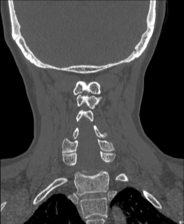 Atlanto-occipital assimilation with basilar invagination (Radiopaedia 70122-80188 Coronal bone window 157).jpg