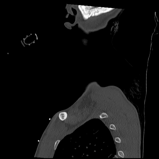 File:Atlanto-occipital dissociation (Traynelis type 1), C2 teardrop fracture, C6-7 facet joint dislocation (Radiopaedia 87655-104061 Sagittal bone window 69).jpg