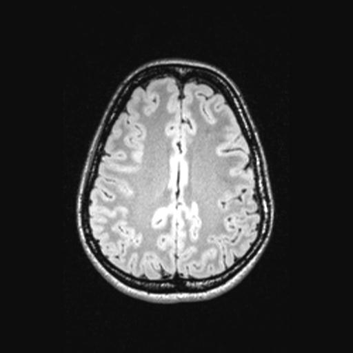 Atretic encephalocoele with inferior vermis hypoplasia (Radiopaedia 30443-31108 Axial 112).jpg
