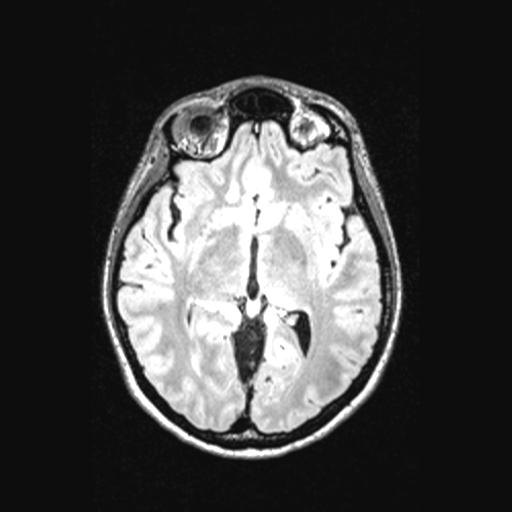 Atretic encephalocoele with inferior vermis hypoplasia (Radiopaedia 30443-31108 Axial 77).jpg