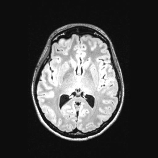 Atretic encephalocoele with inferior vermis hypoplasia (Radiopaedia 30443-31108 Axial 84).jpg
