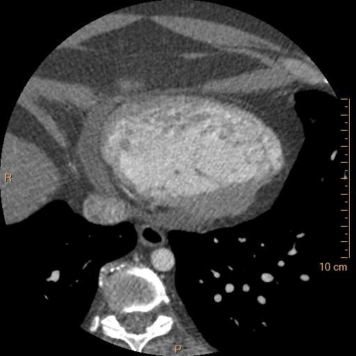 Atrial septal defect (upper sinus venosus type) with partial anomalous pulmonary venous return into superior vena cava (Radiopaedia 73228-83961 A 226).jpg