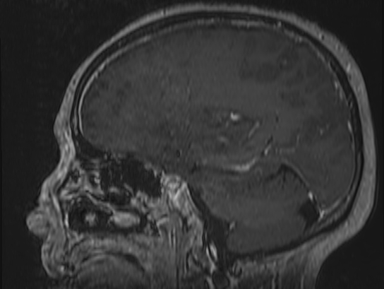 Atypical meningioma (Radiopaedia 62985-71406 Sagittal T1 C+ 55).jpg