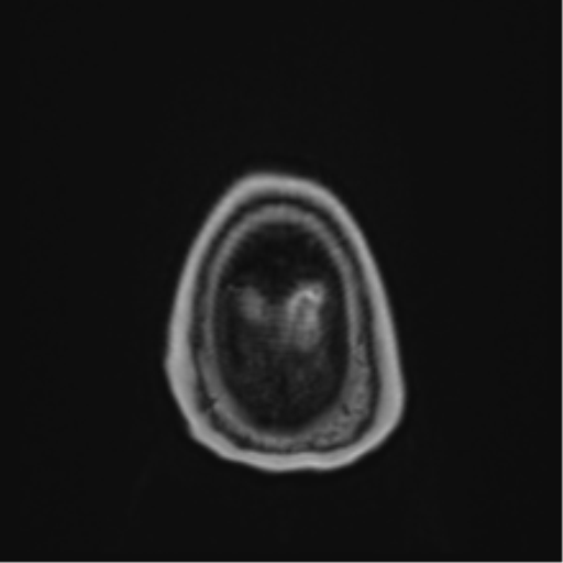 Atypical meningioma (WHO Grade II) (Radiopaedia 54742-60979 Axial T1 C+ 66).png