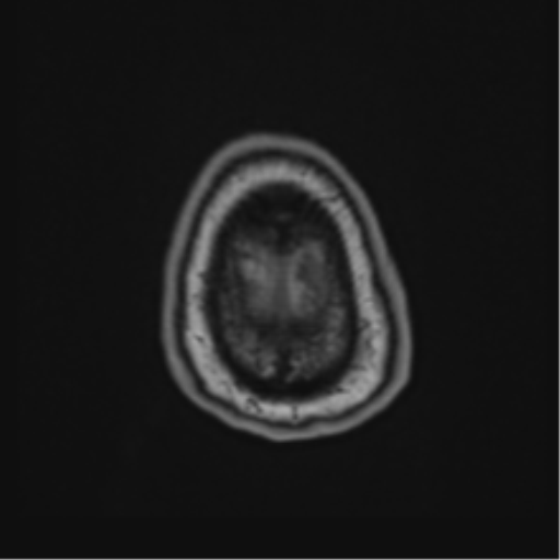 Atypical meningioma (WHO Grade II) (Radiopaedia 54742-60981 Axial T1 68).png