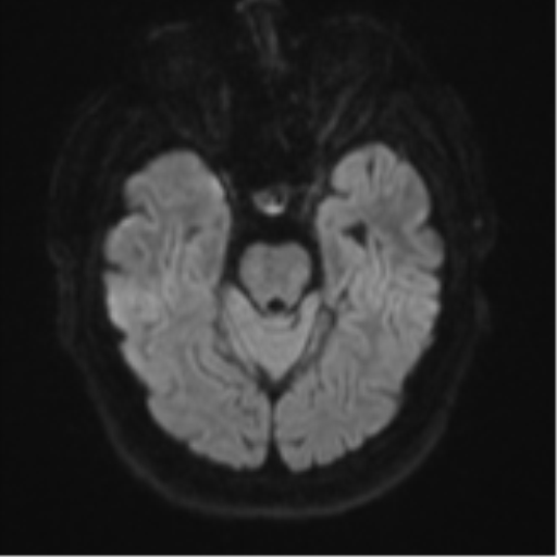 File:Atypical meningioma (WHO grade II) with brain invasion (Radiopaedia 57767-64729 Axial DWI 40).png