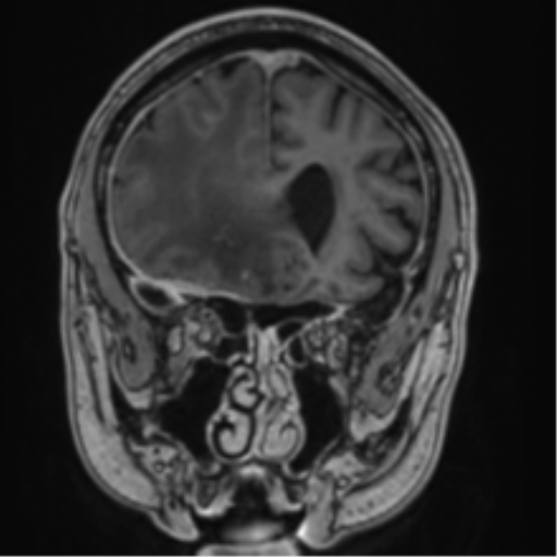 Atypical meningioma (WHO grade II) with brain invasion (Radiopaedia 57767-64729 Coronal T1 C+ 24).png