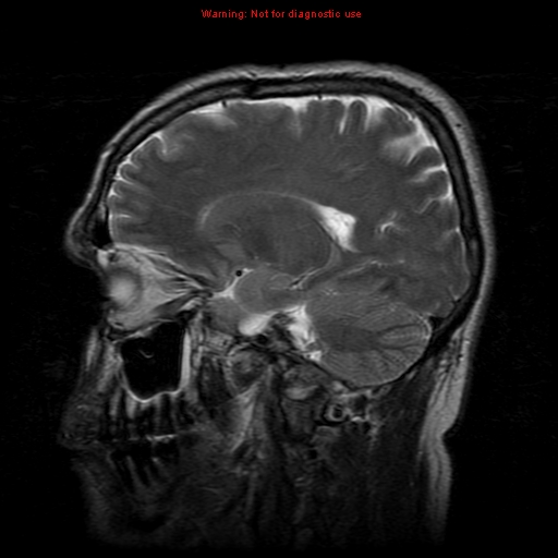 File:Atypical meningioma - grade II (Radiopaedia 13303-13305 Sagittal T2 15).jpg