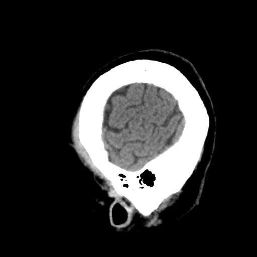 Atypical meningioma with skull invasion (Radiopaedia 34357-35649 E 49).png