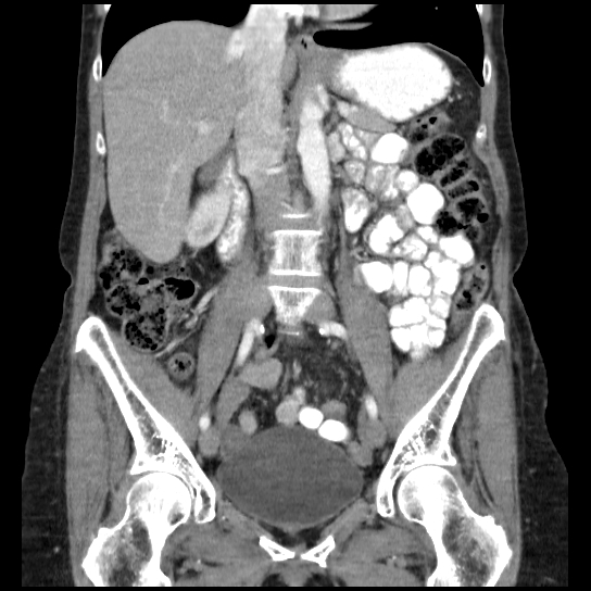 File:Atypical renal cyst (Radiopaedia 17536-17251 C 20).jpg