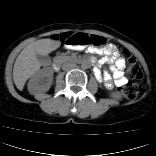 File:Atypical renal cyst (Radiopaedia 17536-17251 non-contrast 20).jpg