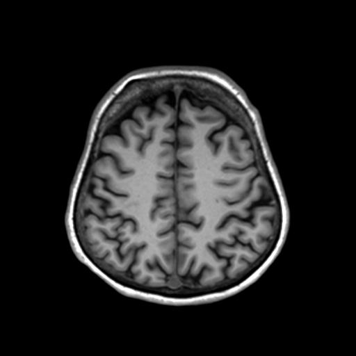 Autoimmune limbic encephalitis (Radiopaedia 30363-31005 T1 Axial 3mm 38).jpg