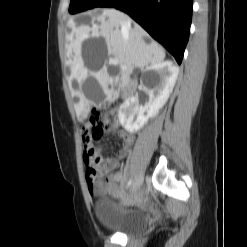 Autosomal dominant polycystic kidney disease (Radiopaedia 23061-23093 F 19).jpg
