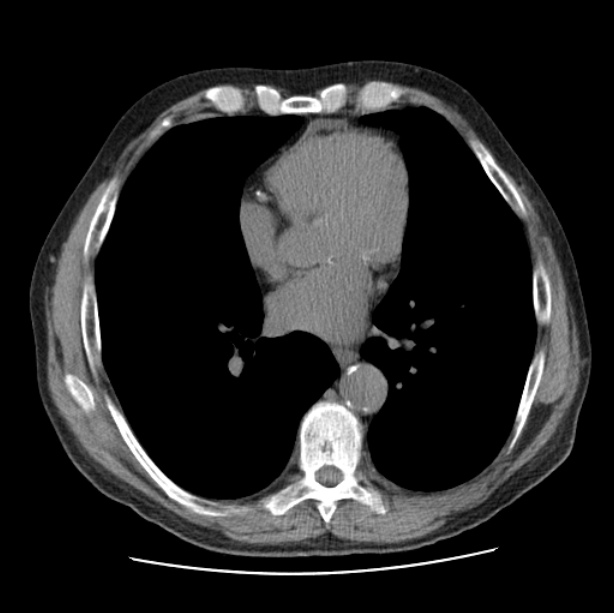 Autosomal dominant polycystic kidney disease (Radiopaedia 27851-28094 Axial non-contrast 34).jpg