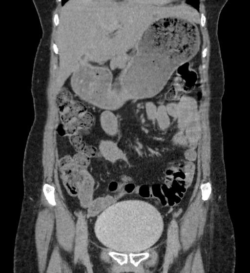 Autosomal dominant polycystic kidney disease (Radiopaedia 38189-40194 Coronal C+ delayed 20).jpg