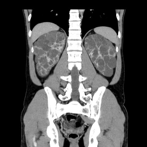 Autosomal dominant polycystic kidney disease (Radiopaedia 66349-75582 A 65).jpg