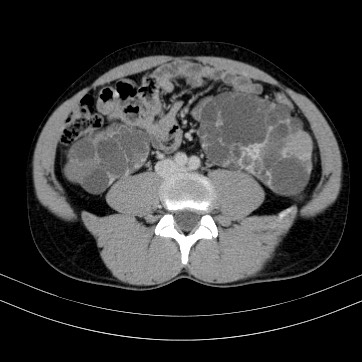 Autosomal dominant polycystic kidney disease (Radiopaedia 66349-75582 B 63).jpg