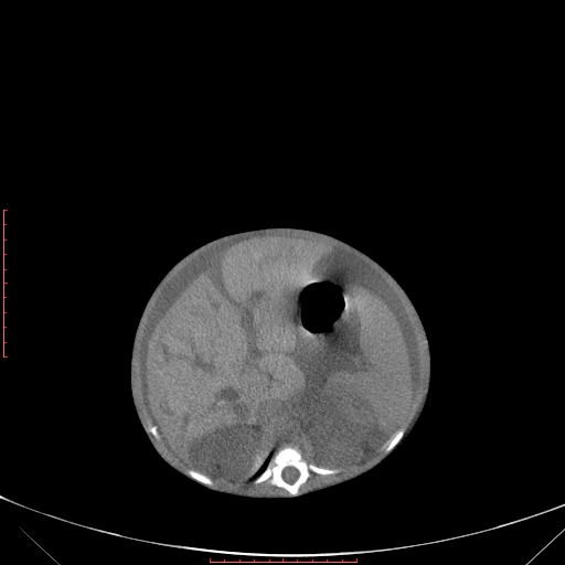 Autosomal recessive polycystic kidney disease associated with Caroli disease (Radiopaedia 61932-69984 Axial non-contrast 156).jpg