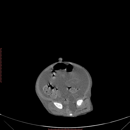 Autosomal recessive polycystic kidney disease associated with Caroli disease (Radiopaedia 61932-69984 Axial non-contrast 314).jpg