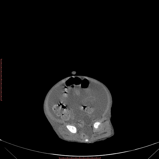 Autosomal recessive polycystic kidney disease associated with Caroli disease (Radiopaedia 61932-69984 Axial non-contrast 316).jpg