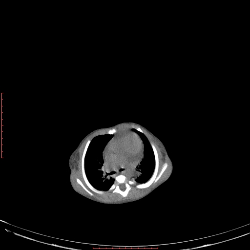 File:Autosomal recessive polycystic kidney disease associated with Caroli disease (Radiopaedia 61932-69984 Axial non-contrast 47).jpg