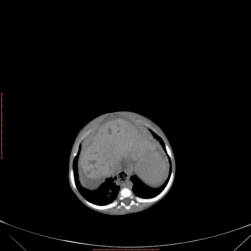 File:Autosomal recessive polycystic kidney disease associated with Caroli disease (Radiopaedia 61932-69984 B 103).jpg