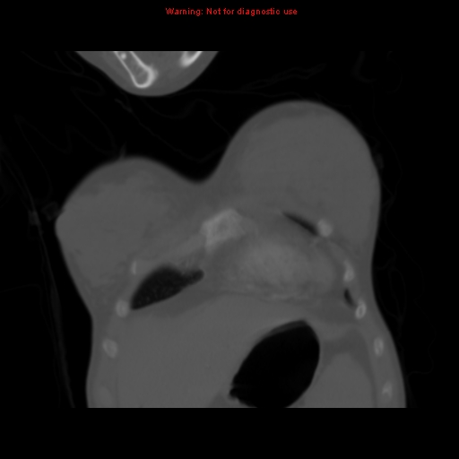 Avascular necrosis in sickle cell disease (Radiopaedia 17448-17152 Coronal bone window 15).jpg