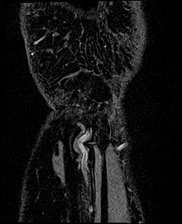 Avascular necrosis of the capitate (Radiopaedia 88317-104948 Coronal T1 vibe 90).jpg